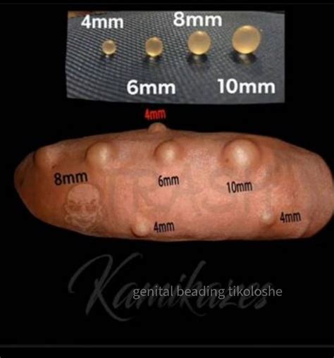 bolitas scandal|He had marbles implanted in an unusual body part. Now he’s .